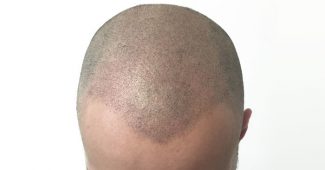 Micropigmentation du cuir chevelu : ce que vous devez savoir