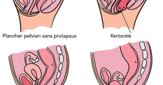 prolapsus génital